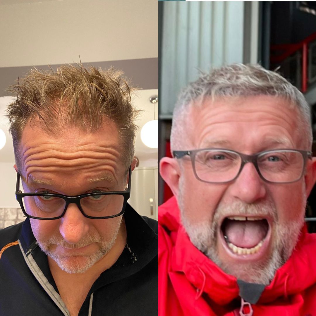 Hair transplant outcome showing natural growth pattern and balanced density