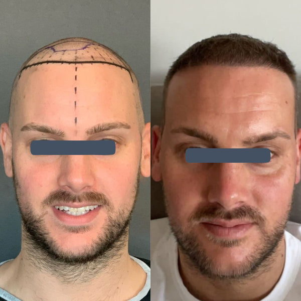 10 Months Post Hair Transplant