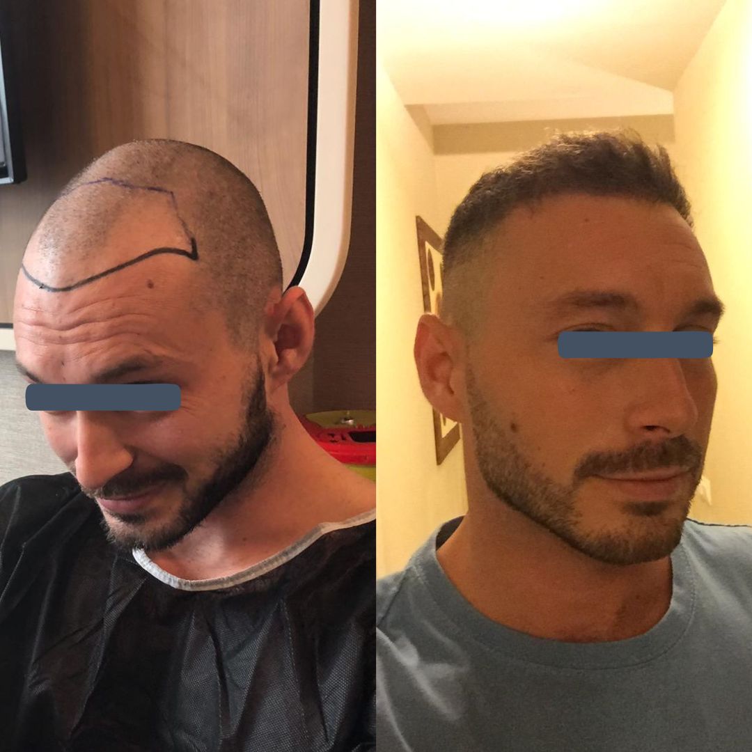 Before and after hair transplant with increased thickness across the top of the scalp