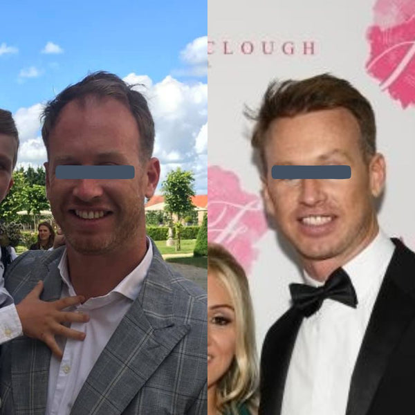 2 Years Post Hair Transplant