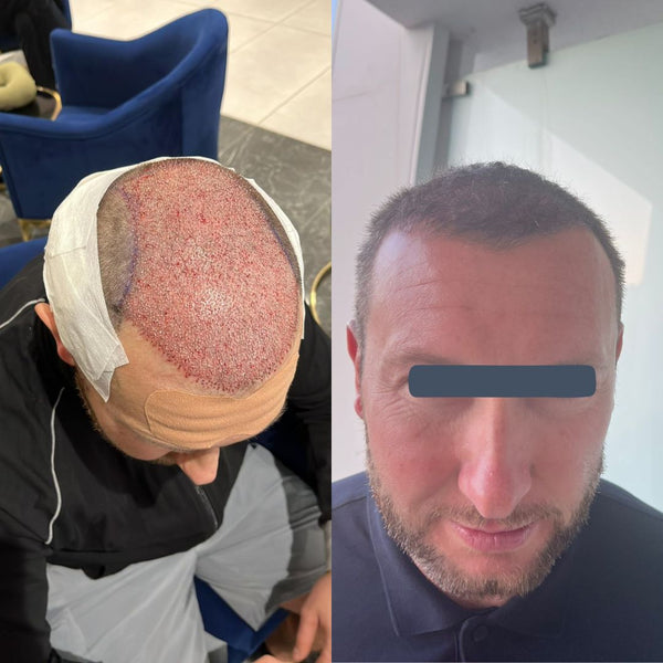 Before and after comparison of a person's scalp with hair loss and a clean-shaven head.