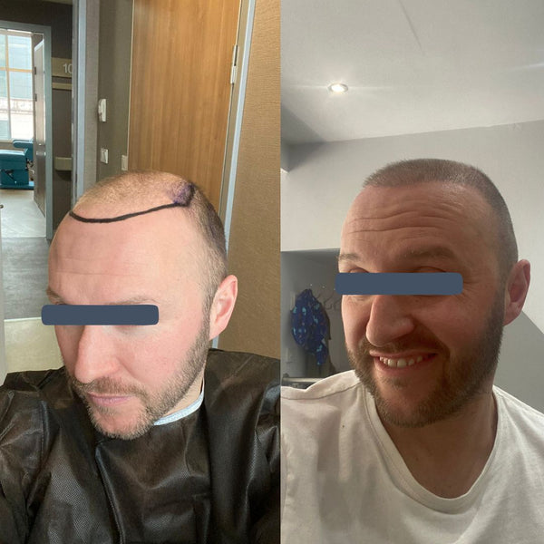 5 Months Post Hair Transplant