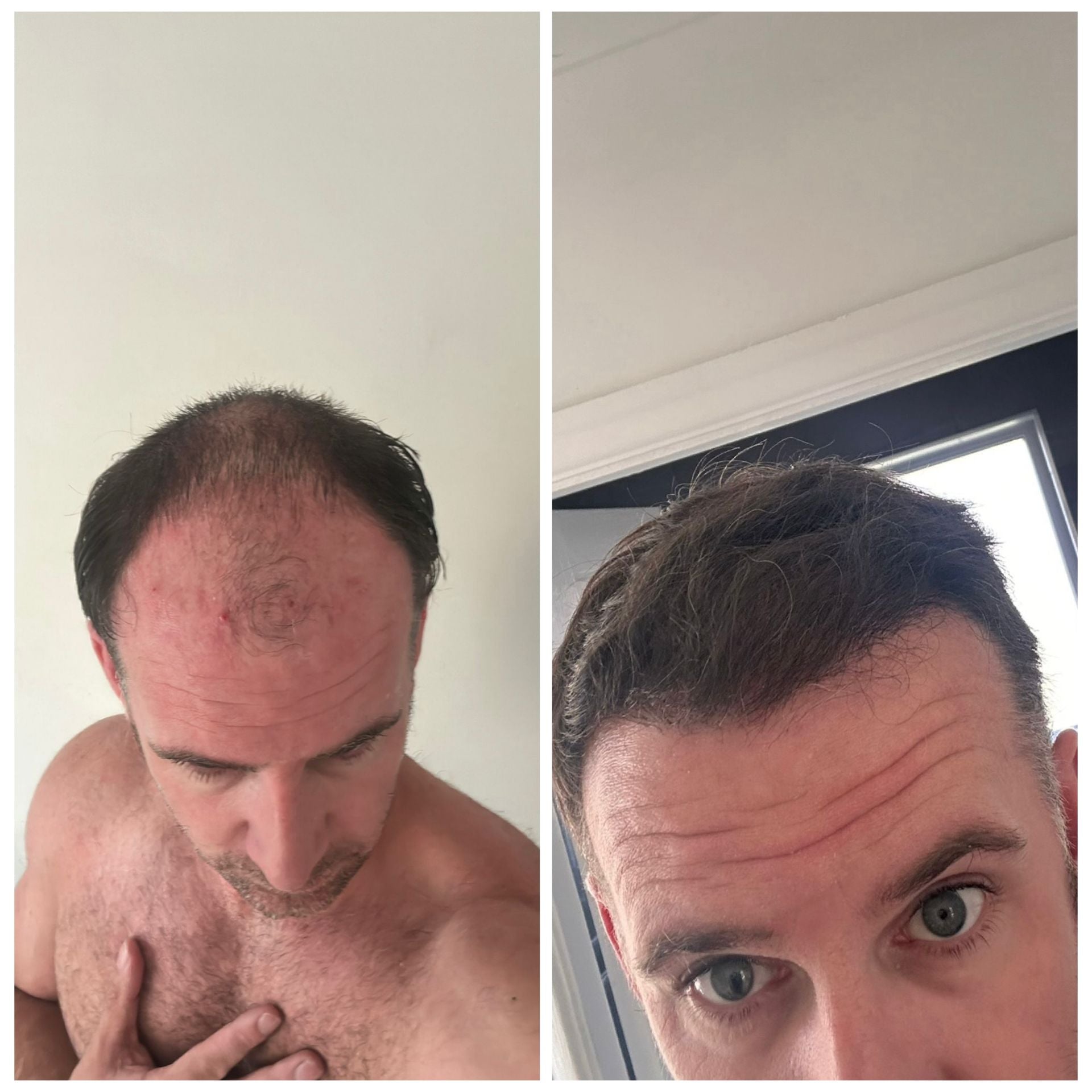 3800 Grafts FUE