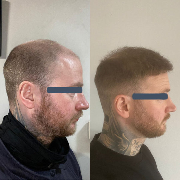 7 Months Post Hair Transplant