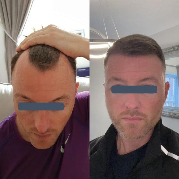 Before and after hair transplant showing thinning across the hairline.