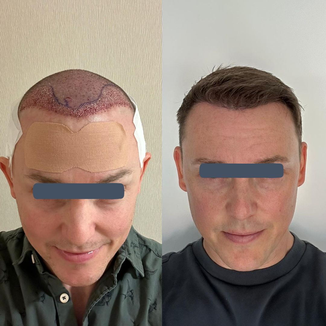Before and after hair restoration photo showing improved hairline definition
