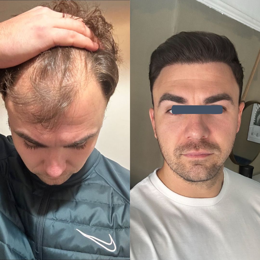 Before and after hair transplant image showing subtle restoration with natural blending