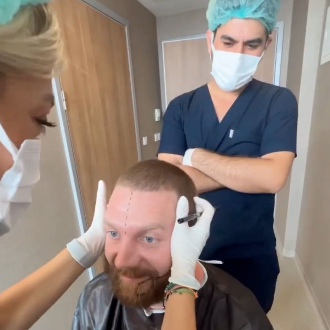 Hair Transplant Deposit (£500)