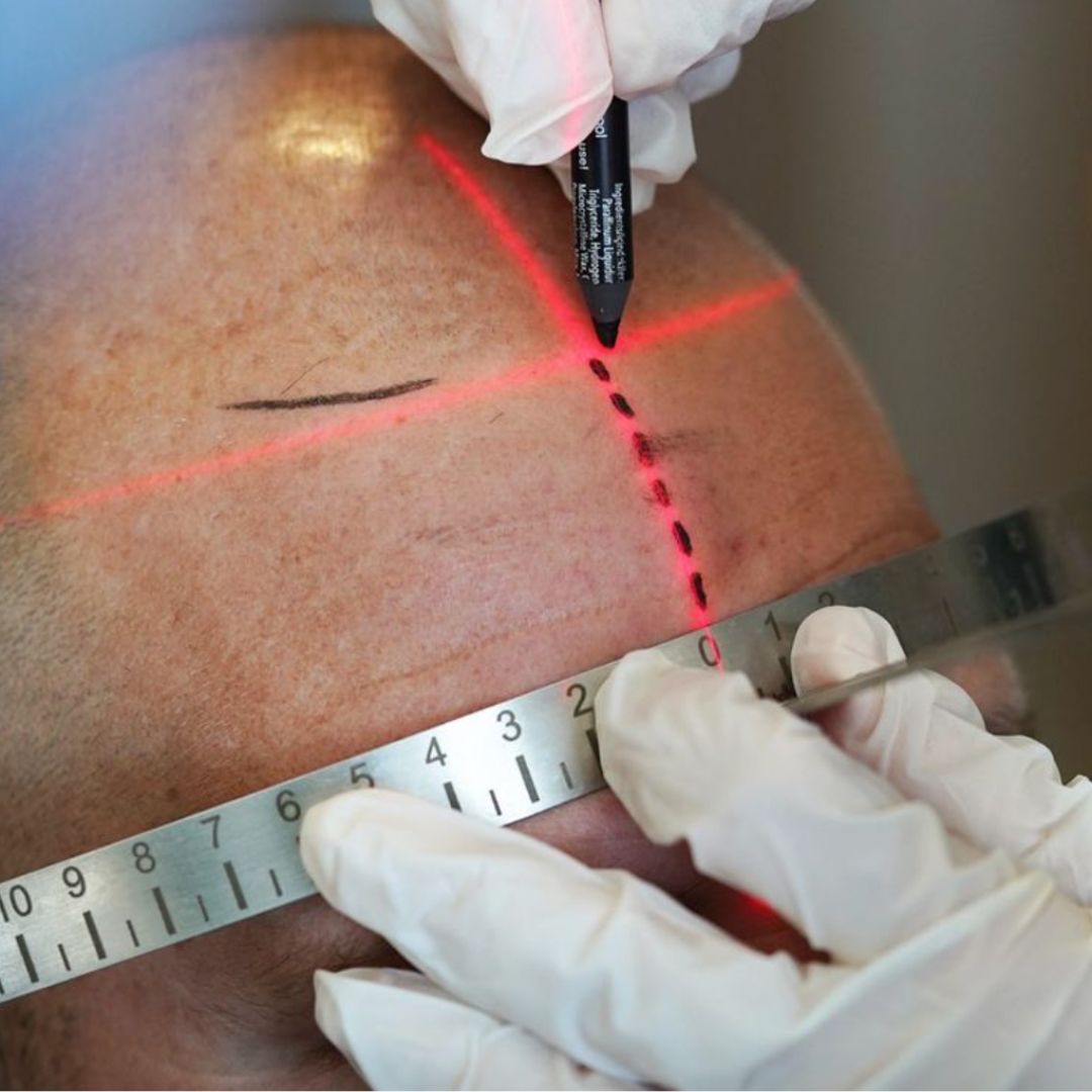 Person measuring skin with a ruler and marking it with a laser pen.
