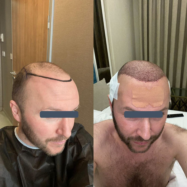 Hair transplant results demonstrating age-appropriate hairline restoration