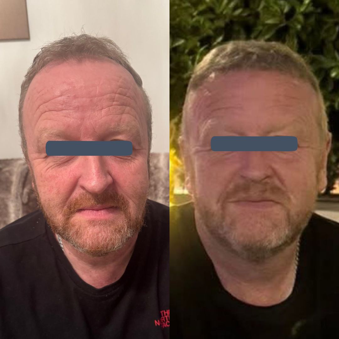 Before and after hair transplant showing age-appropriate hairline restoration and improved density
