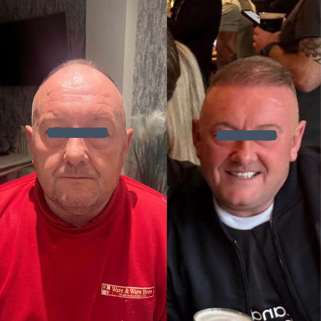 Before and after hair transplant showing age-appropriate hairline restoration and improved density