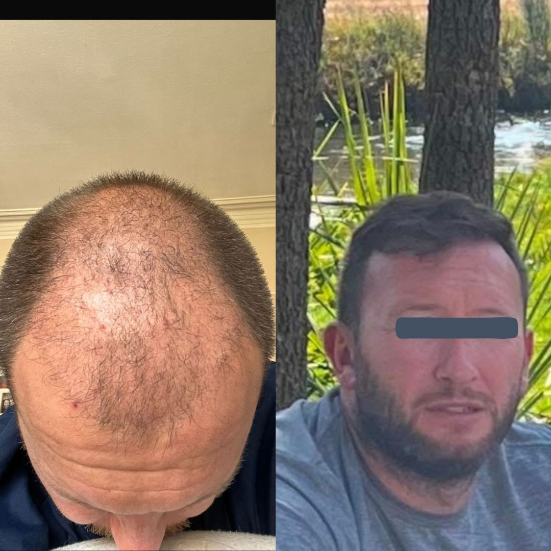 DHI hair transplant before and after – targeted hairline restoration

