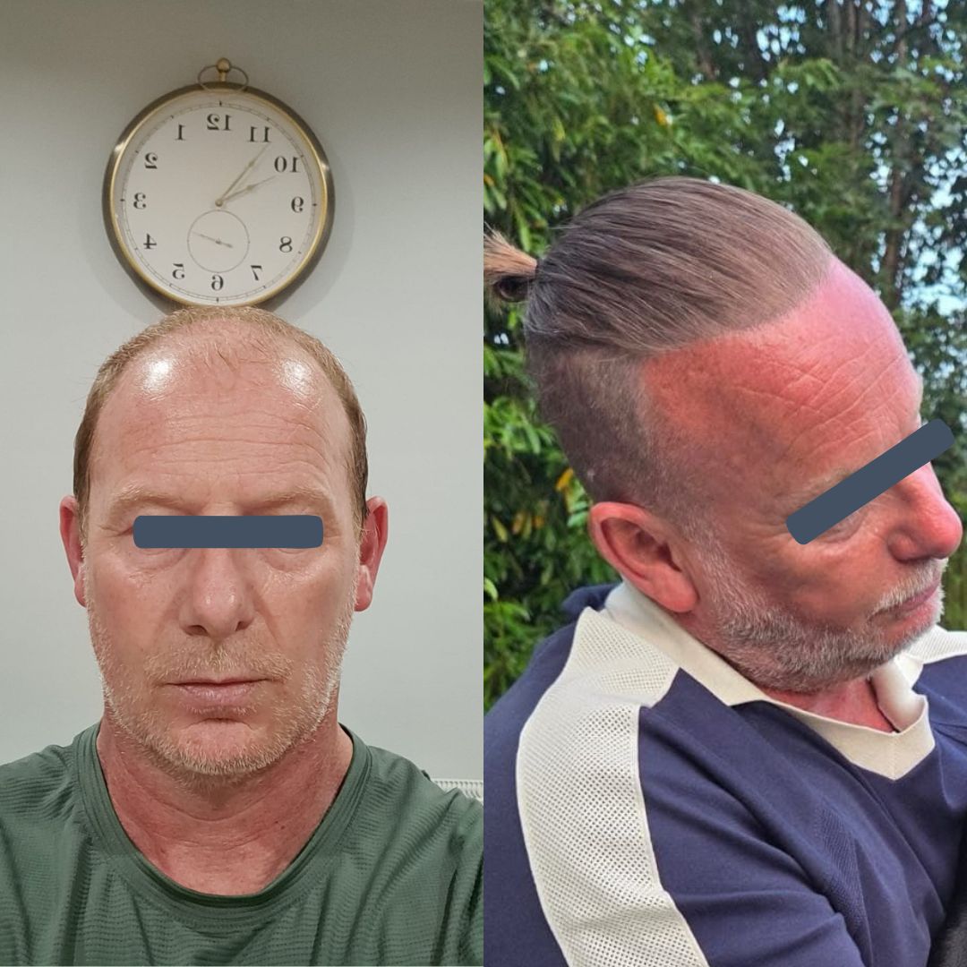 Before and after hair transplant image showing temple recession and fuller hairline shape