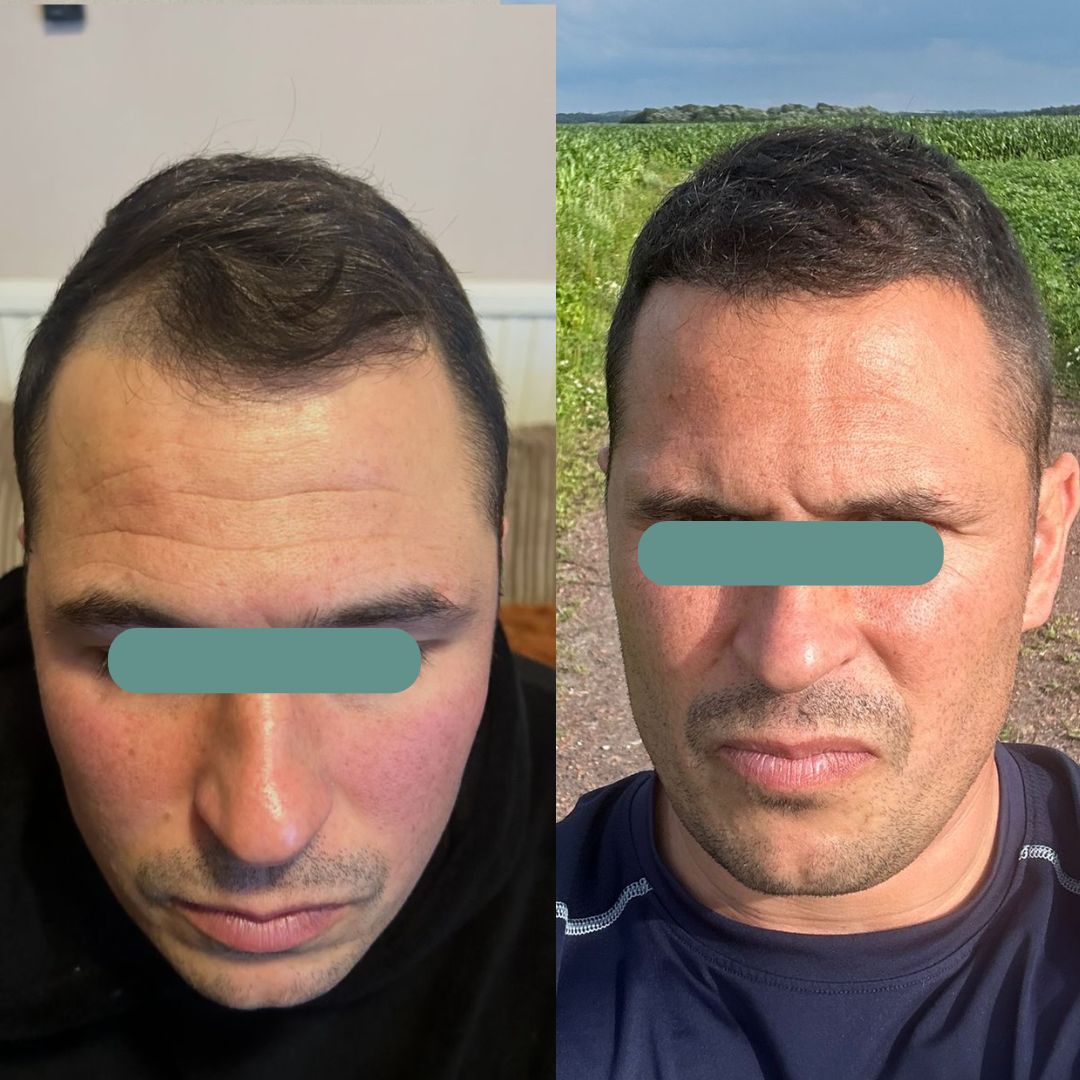 Before and after hair transplant image showing uneven hairline and balanced natural result